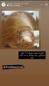 نمونه کار مزوتراپی دکتر صهبا صمدی در مشهد