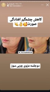 نمونه کار مزوتراپی دکتر فرانک تهرانی در مشهد