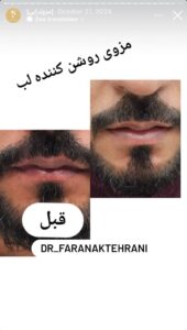 نمونه کار مزوتراپی دکتر فرانک تهرانی در مشهد