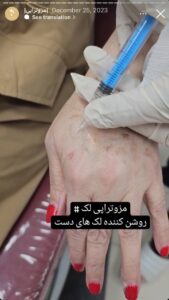 نمونه کار مزوتراپی دکتر فرانک تهرانی در مشهد