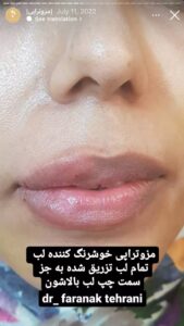 نمونه کار مزوتراپی دکتر فرانک تهرانی در مشهد