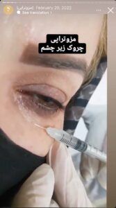 نمونه کار مزوتراپی دکتر فرانک تهرانی در مشهد