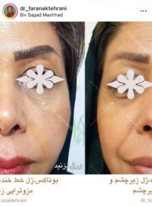 نمونه کار مزوتراپی دکتر فرانک تهرانی در مشهد