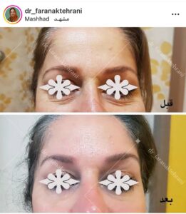 نمونه کار مزوتراپی دکتر فرانک تهرانی در مشهد