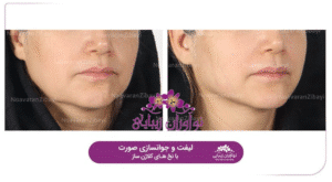 نمونه کار لیفت با نخ (کلینیک نوآوران زیبایی)