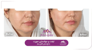 نمونه کار لیفت با نخ (کلینیک نوآوران زیبایی)