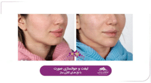 نمونه کار لیفت با نخ (کلینیک نوآوران زیبایی)