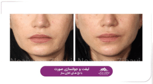 نمونه کار لیفت با نخ (کلینیک نوآوران زیبایی)
