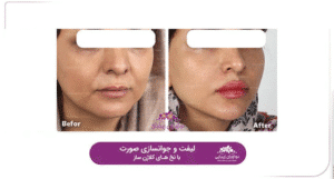 نمونه کار لیفت با نخ (کلینیک نوآوران زیبایی)