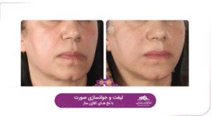 نمونه کار لیفت با نخ (کلینیک نوآوران زیبایی)