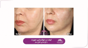 نمونه کار لیفت با نخ (کلینیک نوآوران زیبایی)