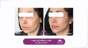 نمونه کار لیفت با نخ (کلینیک نوآوران زیبایی)