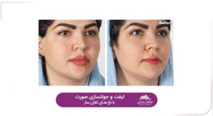 نمونه کار لیفت با نخ (کلینیک نوآوران زیبایی)