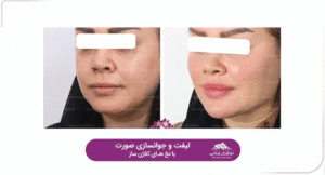 نمونه کار لیفت با نخ (کلینیک نوآوران زیبایی)