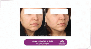 نمونه کار لیفت با نخ (کلینیک نوآوران زیبایی)
