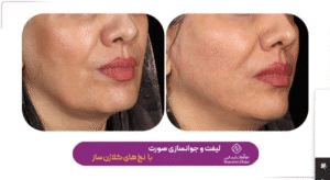 نمونه کار لیفت با نخ (کلینیک نوآوران زیبایی)