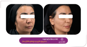 نمونه کار لیفت با نخ (کلینیک نوآوران زیبایی)