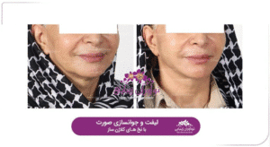 نمونه کار لیفت با نخ (کلینیک نوآوران زیبایی)