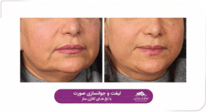 نمونه کار لیفت با نخ (کلینیک نوآوران زیبایی)