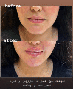نمونه کار لیفت با نخ (دکتر اعظم خانزاده)