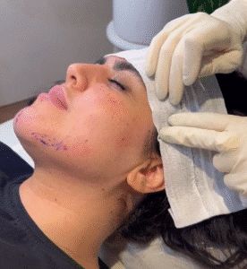نمونه کار لیفت با نخ (دکتر اعظم خانزاده)