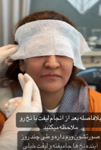 نمونه کار لیفت با نخ (دکتر اعظم خانزاده)