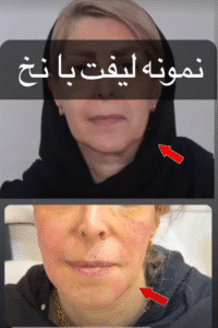 نمونه کار لیفت با نخ (دکتر اعظم خانزاده)