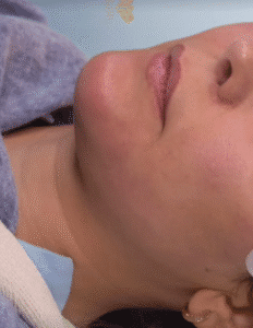 نمونه کار لیفت با نخ (دکتر اعظم خانزاده)
