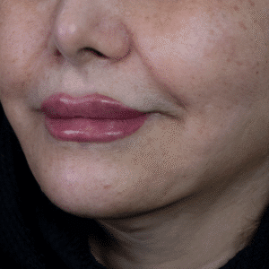 نمونه کار لیفت با نخ (دکتر اعظم خانزاده)