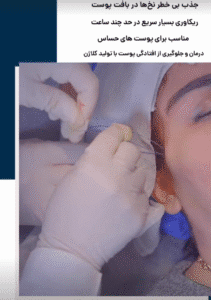 نمونه کار لیفت با نخ (کلینیک سلامت ایده آل)
