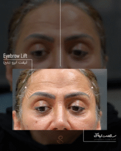 نمونه کار لیفت با نخ (کلینیک سلامت ایده آل)