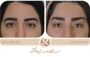 نمونه کار لیفت با نخ (کلینیک سلامت ایده آل)