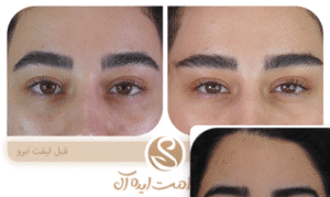 نمونه کار لیفت با نخ (کلینیک سلامت ایده آل)