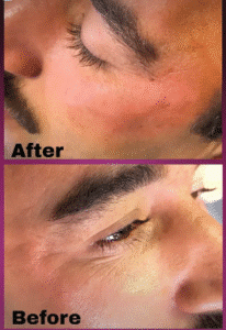 نمونه کار لیفت با نخ (دکتر شیما مطیعی فر)