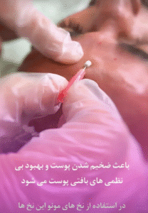 نمونه کار لیفت با نخ (دکتر شیما مطیعی فر)