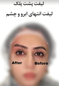 نمونه کار لیفت با نخ (دکتر شیما مطیعی فر)