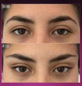 نمونه کار لیفت با نخ (دکتر شیما مطیعی فر)