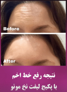 نمونه کار لیفت با نخ (دکتر شیما مطیعی فر)