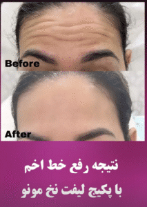 نمونه کار لیفت با نخ (دکتر شیما مطیعی فر)
