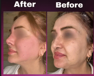 نمونه کار لیفت با نخ (دکتر شیما مطیعی فر)
