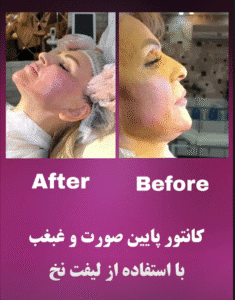 نمونه کار لیفت با نخ (دکتر شیما مطیعی فر)