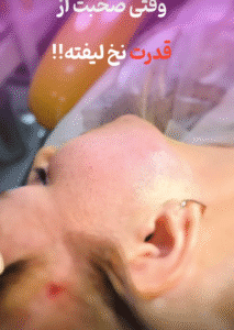 نمونه کار لیفت با نخ (دکتر شیما مطیعی فر)
