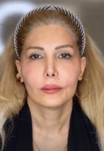نمونه کار لیفت با نخ (دکتر محمود ارجمند)
