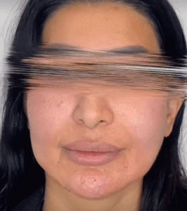 نمونه کار لیفت با نخ (دکتر محمود ارجمند)