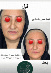 نمونه کار لیفت با نخ (دکتر محمود ارجمند)