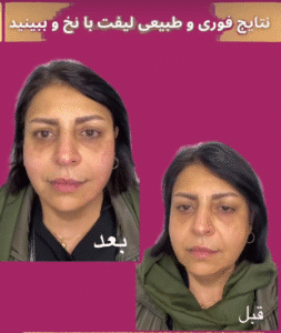 نمونه کار لیفت با نخ (دکتر محمود ارجمند)