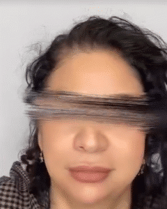 نمونه کار لیفت با نخ (دکتر محمود ارجمند)