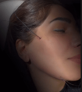 نمونه کار لیفت با نخ (دکتر محمود ارجمند)