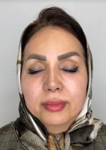 نمونه کار لیفت با نخ (دکتر محمود ارجمند)