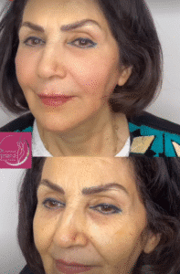 نمونه کار لیفت با نخ (دکتر محمود ارجمند)